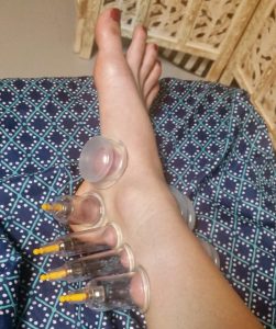 Nine cupping therapy cups are suctioned along the inner and outer portion of a female ankle