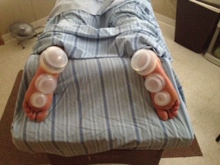 A cupping massage client lays on a massage table. Three cups are suctioned to the bottom of each foot, on the heel, arch and balls of the foot.
