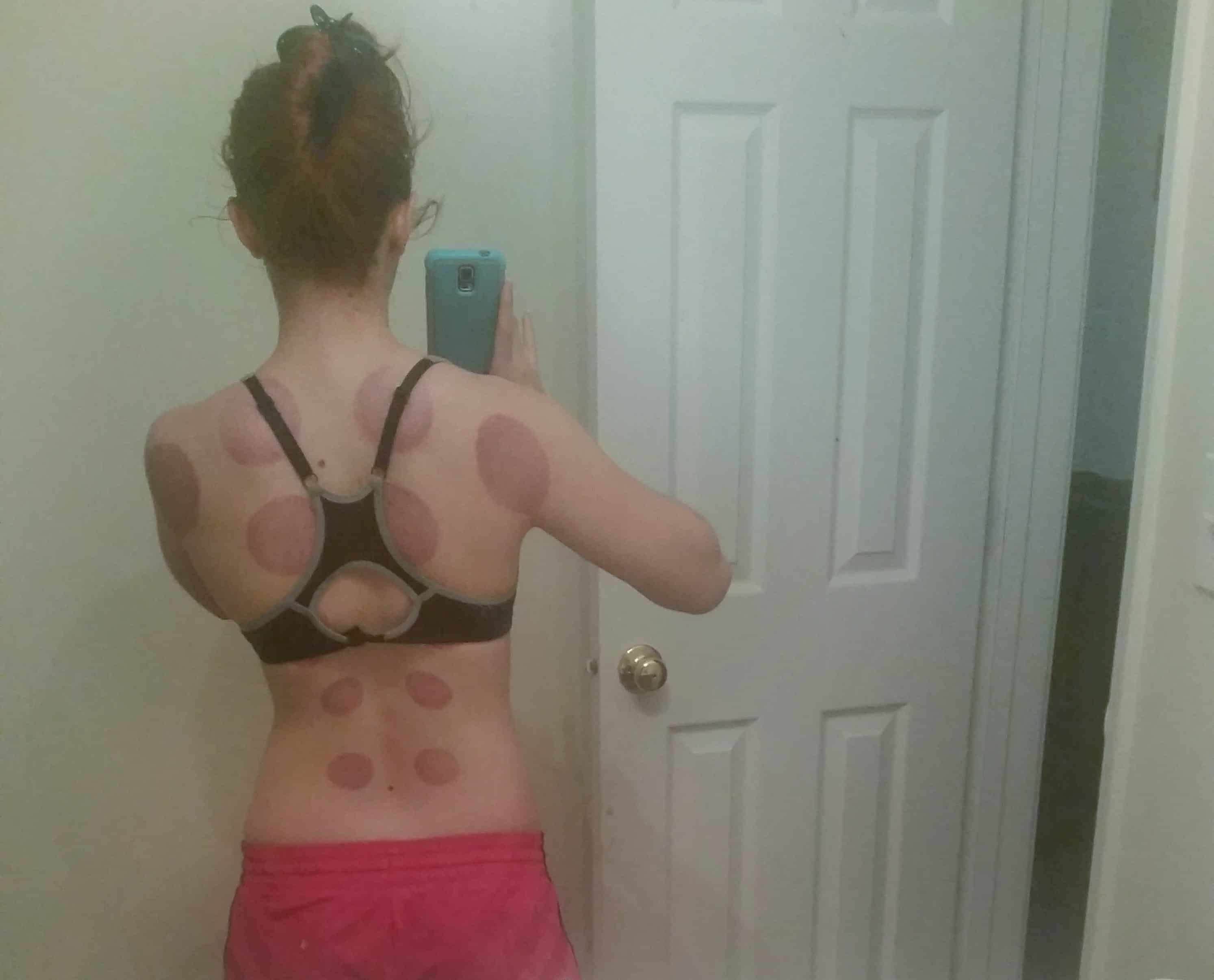 A red haired woman in shorts and a sports bra stands with her back to the camera, her back is covered in 12 cupping marks